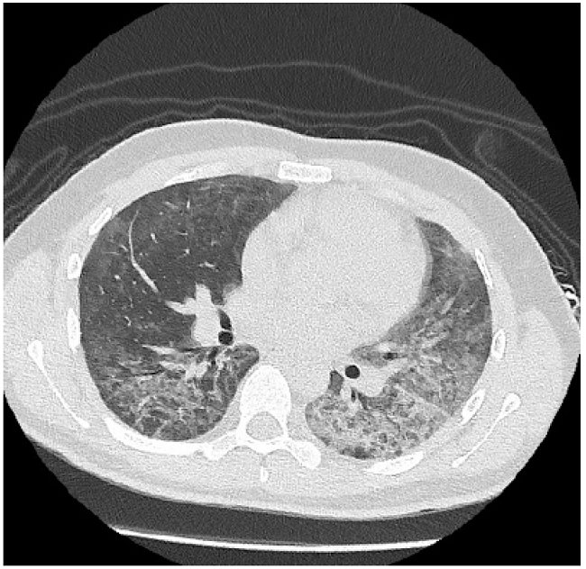 Tomograf&iacute;a axial computarizada de corte transversal de t&oacute;rax que evidencia patr&oacute;n de vidrio esmerilado y aumento de broncograma a&eacute;reo en a&eacute;reas de condensaci&oacute;n en bases pulmonares.