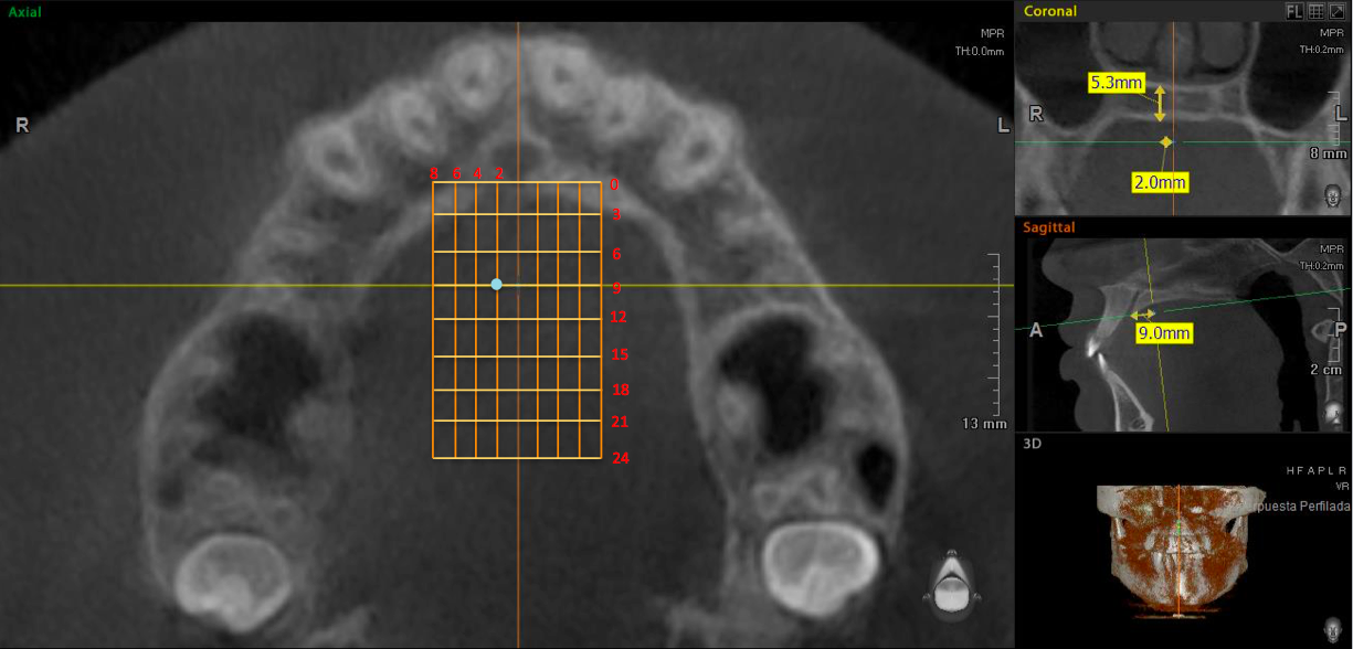 Cuadrcula del paladar. Grosor palatino de 5.3mm a los 2mm (sagital) y 9mm (coronal) del lado derecho.