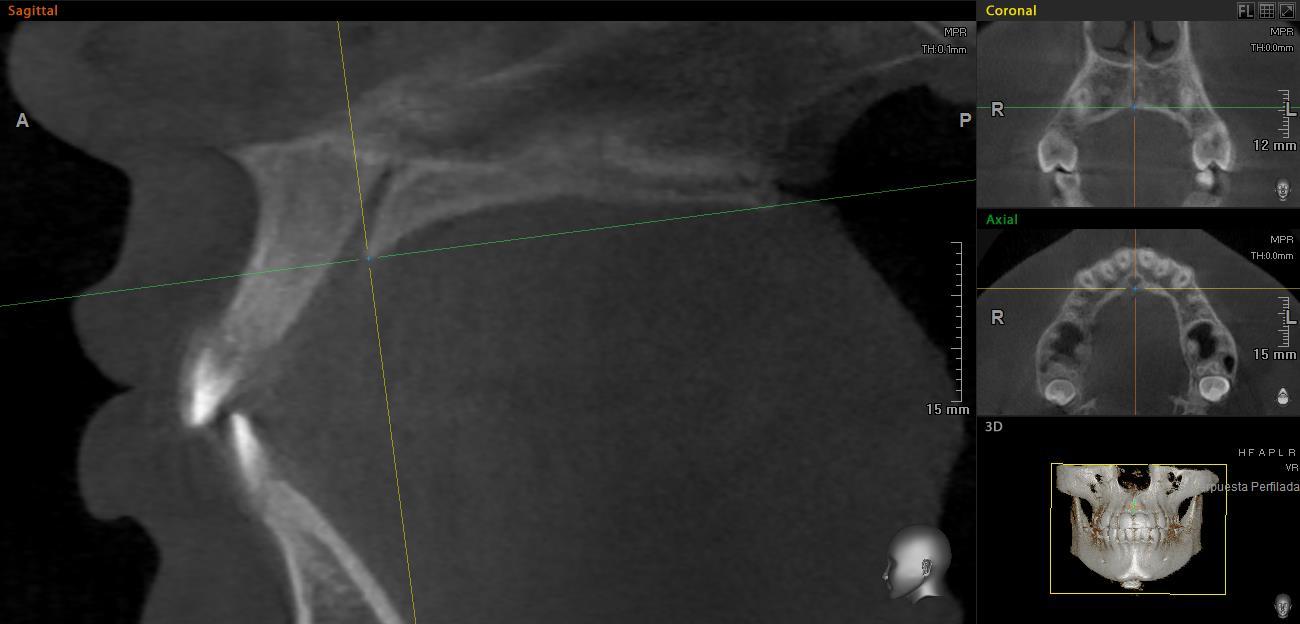 Plano axial posicionado en el borde posterior del foramen incisivo y espina nasal posterior