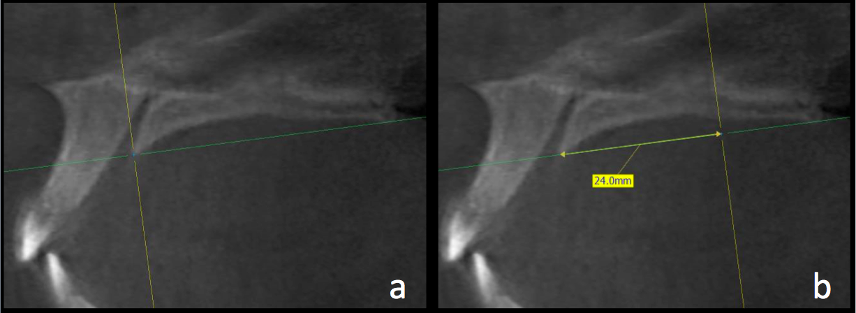 Interseccin de plano axial y coronal a los 0mm (a) y 24mm (b)