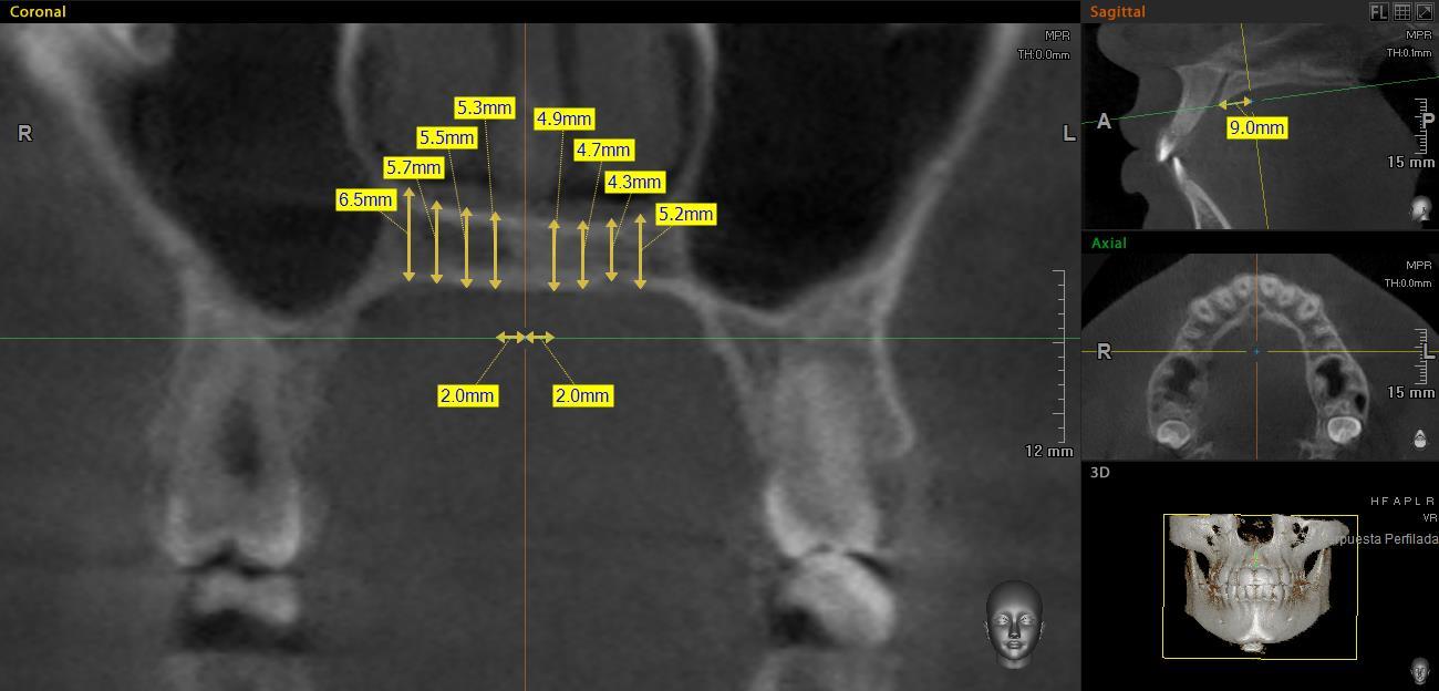 Grosor palatino medido a los 9mm del borde posterior del foramen incisivo