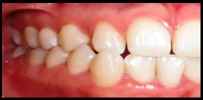 Imagen de diastema en piezas 12 y 14