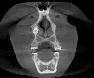 Tomografa realizada para mejor observacin de la ubicacin de la pieza dentaria