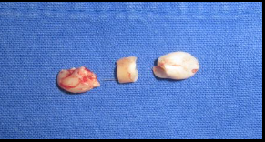 Odontoseccin de la pieza dentaria
