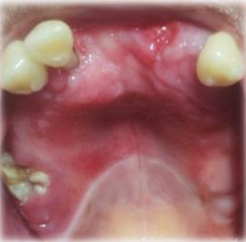 Eritema intenso en paladar duro. Recesin gingival dientes antero-superiores
