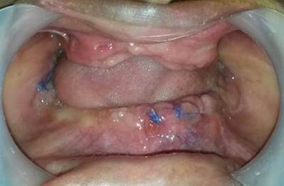Regularizacin de reborde alveolar mediante intervencin quirrgica