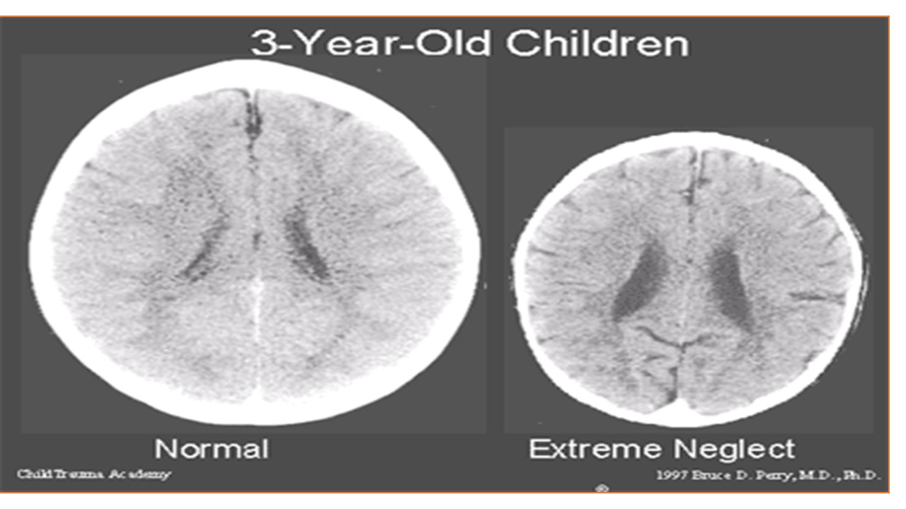 Comparativo del desarrollo cerebral en niños de tres años de edad con y sin adecuado cuidado. Bruce Perry (1997)