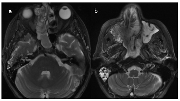 RMN de MCF. Secuencia T2 serie sin contraste endovenoso. Cortes axiales. Lesi&oacute;n de partes blandas, con &aacute;reas de se&ntilde;al hiperintensa y de baja se&ntilde;al. Determina marcado desplazamiento del tabique nasal, obliterando trompa de Eustaquio derecha, con ocupaci&oacute;n de celdillas mastoideas y o&iacute;do medio homolaterales.
