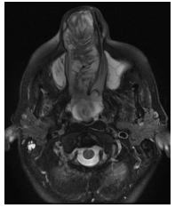 RMN de MCF. Secuencia T2 serie sin contraste endovenoso. Corte axial.