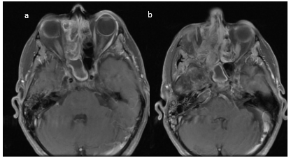 RMN de MCF. Secuencia T1 serie con contraste endovenoso. Cortes axiales (a y b).                         Figura 12. RMN de MCF. Secuencia T1 serie con contraste endovenoso. Corte axial. Se observa realce postcontraste.                       Figura 13. RMN de MCF. Secuencia T1. Serie con contraste endovenoso. Cortes coronales (a y b).           Importar tabla