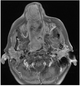 RMN de MCF. Secuencia T1 serie con contraste endovenoso. Corte axial. Se observa realce postcontraste.