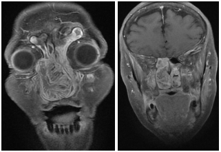 RMN de MCF. Secuencia T1. Serie con contraste endovenoso. Cortes coronales (a y b).