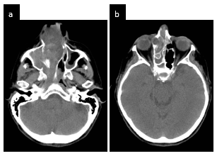 TC sin contraste endovenoso. Cortes axiales. Imagen con densidad de partes blandas con extensi&oacute;n a seno maxilar y celdillas etmoidales (a y b).