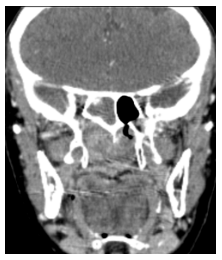 TC sin contraste endovenoso. Corte coronal. Extensi&oacute;n a hemiseno esfenoidal derecho.