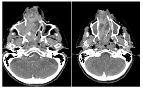 TC de MCF con contraste endovenoso. Cortes axiales.Protrusi&oacute;n hacia las coanas y Cavum con marcado realce postcontraste (a y b).