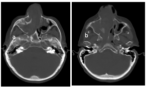 TC ventana &oacute;sea. Cortes axiales. Marcada remodelaci&oacute;n &oacute;sea, predominantemente en fosa nasal y seno maxilar derecho (a y b).