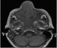 RMN de MCF. Secuencia T1 serie sin contraste endovenoso. Corte axial. Lesi&oacute;n expansiva s&oacute;lida ubicada sobre seno maxilar derecho, que se extiende rodeando la pared interna del seno maxilar hacia fosa nasal homolateral.