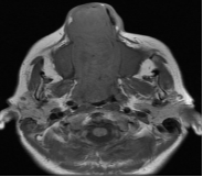 RMN de MCF. Secuencia T1 serie sin contraste endovenoso. Corte axial. La lesi&oacute;n se proyecta desde orificio nasal hasta Cavum y coanas.