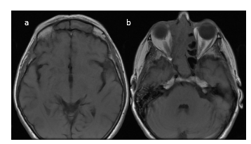 RMN de MCF. Cortes axiales. Extensi&oacute;n hasta senos frontales y erosi&oacute;n de la l&aacute;mina papir&aacute;cea (a y b).