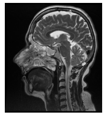 RMN de MCF. Secuencia T2 serie sin contraste endovenoso. Corte sagital. Extensi&oacute;n a senos paranasales, fosas nasales, Cavum y coanas.