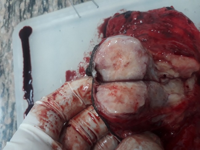 Tumor con corte transversal, muestra un par&eacute;nquima blanco gris&aacute;ceo, firme de bordes regulares.