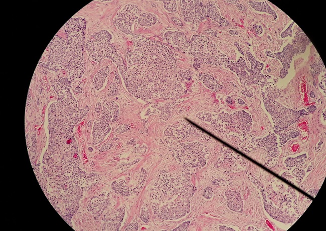 Carcinoma de c&eacute;lulas en anillo de sello 10x, muestra disposici&oacute;n s&oacute;lida con abundantes desmoplasia.