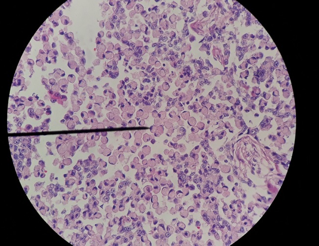 Carcinoma de c&eacute;lulas en anillo de sello 40x, c&eacute;lulas neopl&aacute;sicas con n&uacute;cleos exc&eacute;ntricos en forma de media luna y citoplasma eosinof&iacute;lico bien delimitado