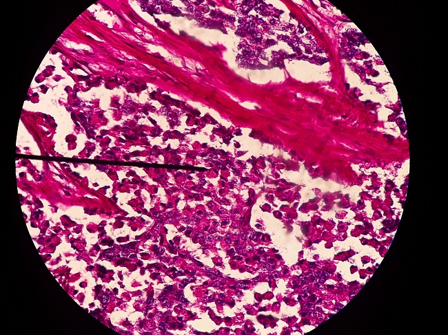 Carcinoma de c&eacute;lulas en anillo de sello 40x, tinci&oacute;n PAS+ intracitoplasmatica.