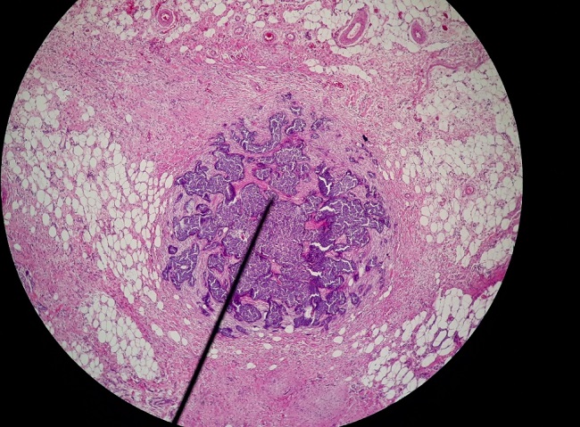 Carcinoma de c&eacute;lulas en anillo de sello 4x, recidiva 30 d&iacute;as post cirug&iacute;a