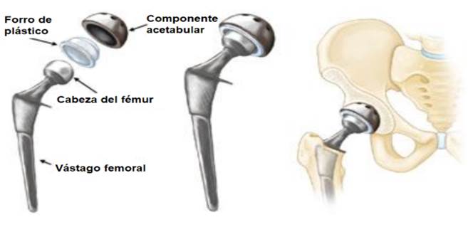 endoprotesis de cadera que consta de cuatro componentes para imitar la funci�n natural de la articulaci�n [22].