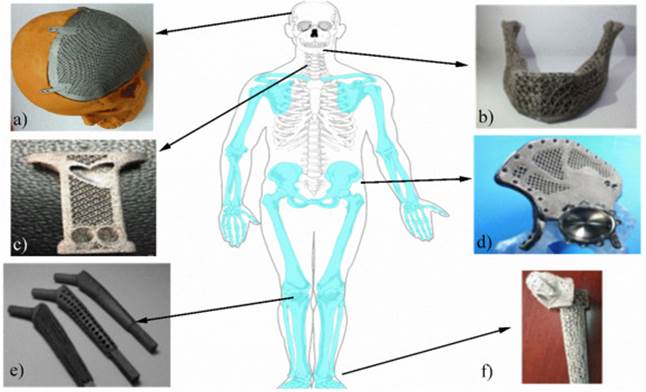 Ejemplo de implantes met�licos. a) placa craneal, b) pr�tesis mandibular, c) caja de fusi�n vertebral, d) implante p�lvico, e) v�stagos para endopr�tesis, f) implante de tobillo [50]&ndash;[52][53].