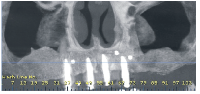 CB-CT de control previo a la instalaci&oacute;n de implantes, a 6 meses de la resoluci&oacute;n del cuadro cl&iacute;nico.