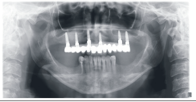 Radiograf&iacute;a panor&aacute;mica de control a los 3 a&ntilde;os del cuadro cl&iacute;nico. Se puede observar estabilidad de los tejidos periimplantarios y ambos senos maxilares sanos.