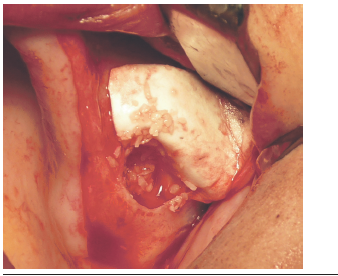 La perforaci&oacute;n fue resuelta de acuerdo a los protocolos, con membrana de col&aacute;geno reabsorbible (Biomend extend, Zimmer, USA) para dar estabilidad al injerto.