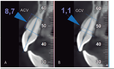 Corte sagital de incisivo central donde se observa el método de medición de las variables: A. medición de la altura de la cresta ósea vestibular desde una línea proyectada hacia vestibular del ápice dentarlo hasta el punto más alto de hueso; B. medición del grosor óseo vestibular a 4 mm apical a la línea.