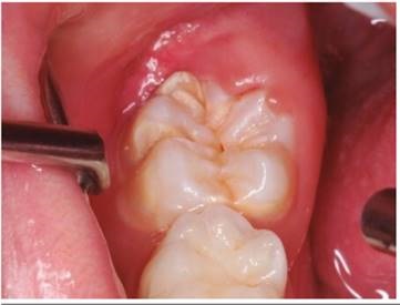Pieza 46 con HIM (B 3 II) (B: Erupcionado, 3: Perdida de estructura, II: 1/3 a 2/3 de extensi&oacute;n), con fisuras y fosas profundas.
