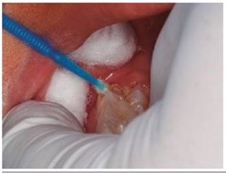 Aislamiento relativo, aplicaci&oacute;n del Brix 3000 por 30 segundos y remoci&oacute;n con cureta (Mayleffer N&deg; 46).