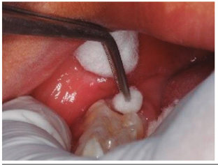 Desproteinizaci&oacute;n con hipoclorito de sodio al 5% por 30 segundos, lavado y secado con bolitas de algod&oacute;n.