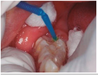 Aplicaci&oacute;n de adhesivo Palfique 7&deg; generaci&oacute;n, aireado y fotocurado por 20 segundos.