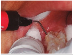 Reconstrucci&oacute;n cara ocluso vestibular con Gi&oacute;mero F00, y modelado con bru&ntilde;idor cabeza de huevo y fotocurado por 20 segundos.