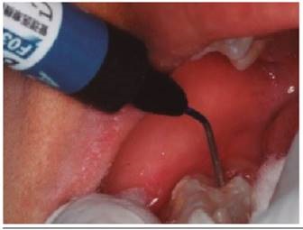 Sellado de fosas y fisuras con Gi&oacute;mero 03, fotocurado por 20 segundos.