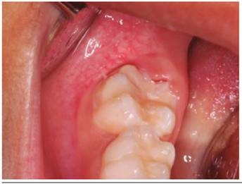 Control de oclusi&oacute;n y anatom&iacute;a dental.