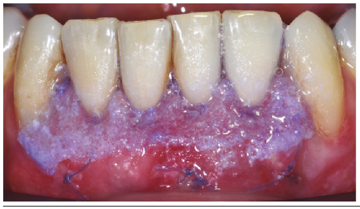 Flap stabilization: Layers of a tissue adhesive (PeriAcryl 90 HV, GluStitch. Canada) were used to protect and immobilize the surgical area.