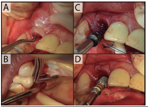 Inserción del nuevo implante. A colgajo tipo sobre conservando la integridad de las papilas y decolamiento de tejidos mediante instrumental específico para su posterior tracción coronal libre de tensión. B toma de injerto de tejido conectivo en bolsillo desde el paladar. C protocolo de fresado bajo irrigación continua de suero fisiológico. D inserción del implante en posición protésicamente ideal