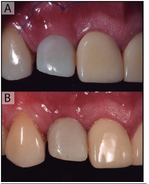 Provisionalización. A control a los 14 días. Se observa margen gingival en posición ideal. En el control a los 6 meses (B) se observa una leve migración apical de margen gingival, pero con tejidos estables y en salud