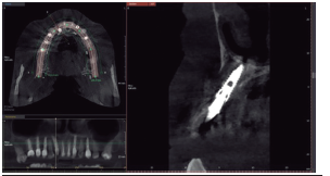Cone beam de control post quirúrgico. Se observa el implante provisionalizado y la recuperación ósea en la zona vestibular