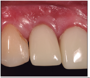 Control final post-cementación de la prótesis fija libre de metal. Se observa una posición levemente más alta del margen gingival con respecto a 1.1 y 1.3. La papila mesial está perfectamente conservada, mientras que la papila distal sufrió una leve retracción