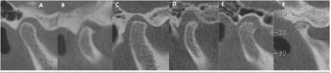 Cortes sagitales oblicuos de ATM en máxima intercuspidación (MIC). La morfología del cóndilo se clasificó en A) sin cambios óseos; B) osetofito; C) aplanamiento; D) esclerosis; E) erosión y F) pseuodquiste. Imagen tomada de Dos Anjos Pontual ML, Freire JSL, Barbosa JMN, Frazão MAG, Dos Anjos Pontual A. Evaluation of bone changes in the temporomandibular joint using cone beam CT