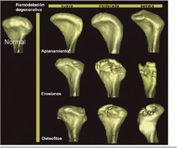 Se muestra la asociación de la forma condilar asociada a los cambios. el eje vertical describe progresión (aplanamiento, erosiones y osteofitos) de los cambios degenerativos, mientras que el eje horizontal representa la severidad. Imagen tomada de Cevidanes LH, Walker DG, Styner M, Lim PF. Condylar Resorption in Patients With Tmd