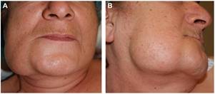 Vista frontal (A) y sagital (B) de examen facial. Aumento de
volumen cervicofacial derecho